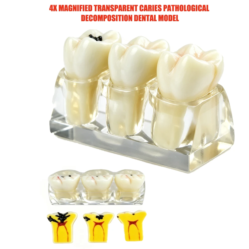 Dental Caries Model Four Stage Caries Decomposition  Pathology Study Dentist Teaching Caries Progression Demonstration Model