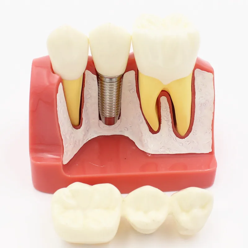 Dental 4 times planting Teeth model Analysis Crown Bridge Removable Model Dental Demonstration Teeth Model