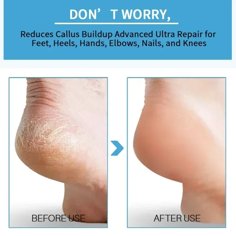 Foot Peeling Spray ขัดเท้าถอด Dead Skin Calluses Feet Care เครื่องมือ Repairing Health Care 