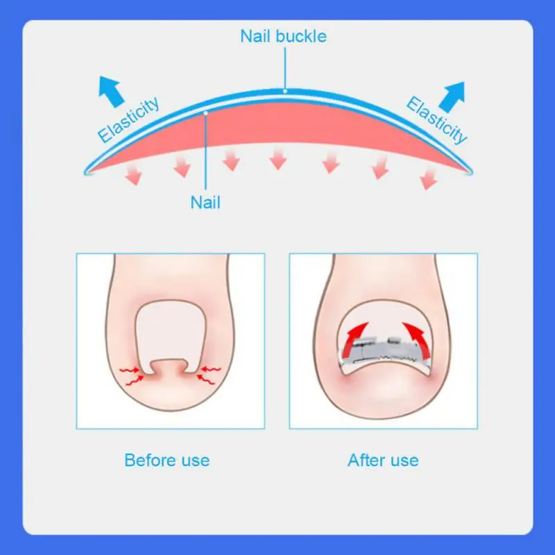 เล็บเท้าคุดแก้ไขเล็บสแตนเลส Relief อุปกรณ์ยืดปวดเครื่องมือทำเล็บเท้าสำหรับกู้คืนเล็บเท้าคุด