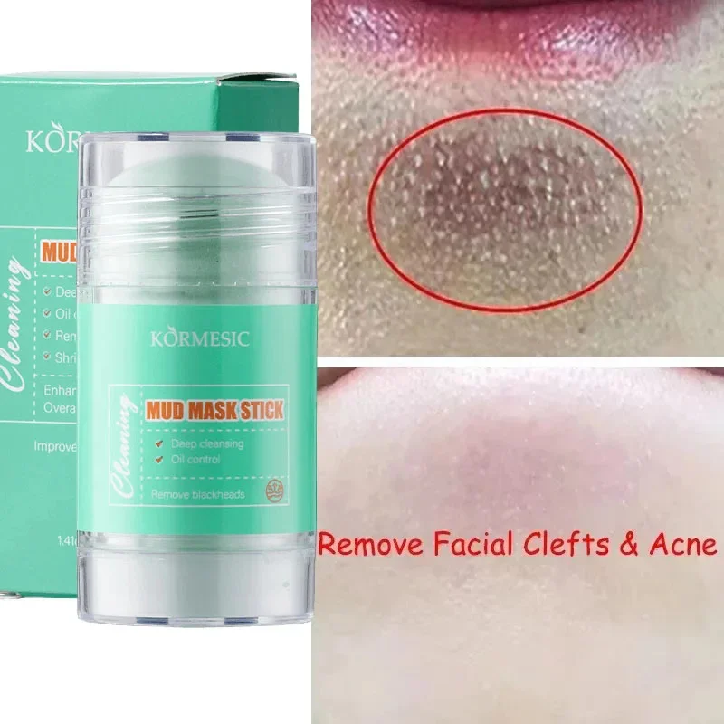 

Original Facial Remove Blackhead Niacinamide Solid Mask Treat Acne Blemish Black Dots Clean Stick Cream Shrink Pores Skin Care