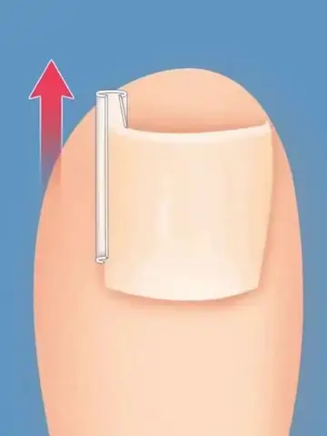 50Pcs Ingrown Toenail Correction Tool Ingrown Toe Nail Treatment Elastic Patch Sticker Straightening Clip Brace Pedicure Tool