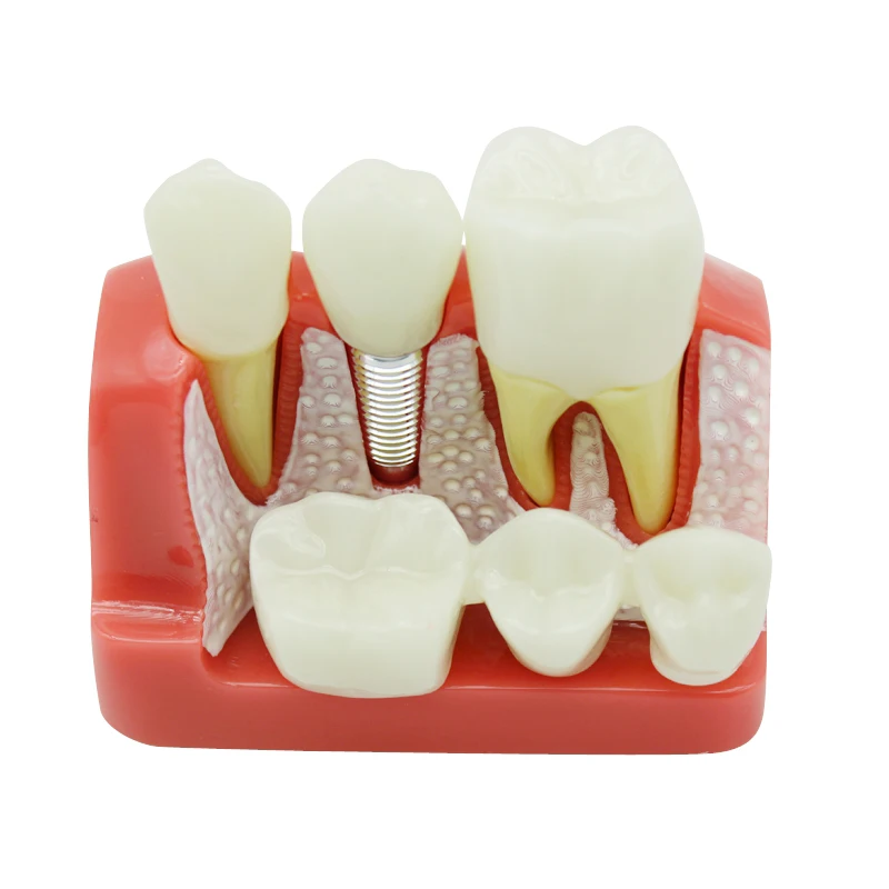 

Dental Teach Implant Analysis Crown Bridge Removable Model Dental Demonstration Teeth Model 4 Times Dentistry