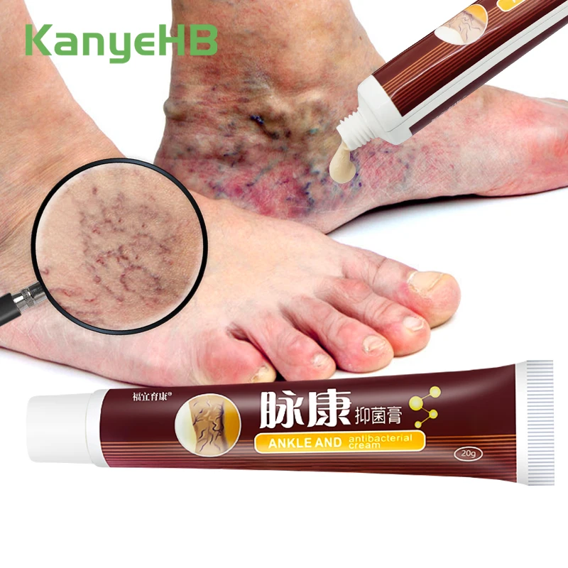 1Pcs Varicose Veins Treatment Cream Remove Red Blood Streaks Varicocele Vasculitis Phlebitis Strengthen Capillary Health S034