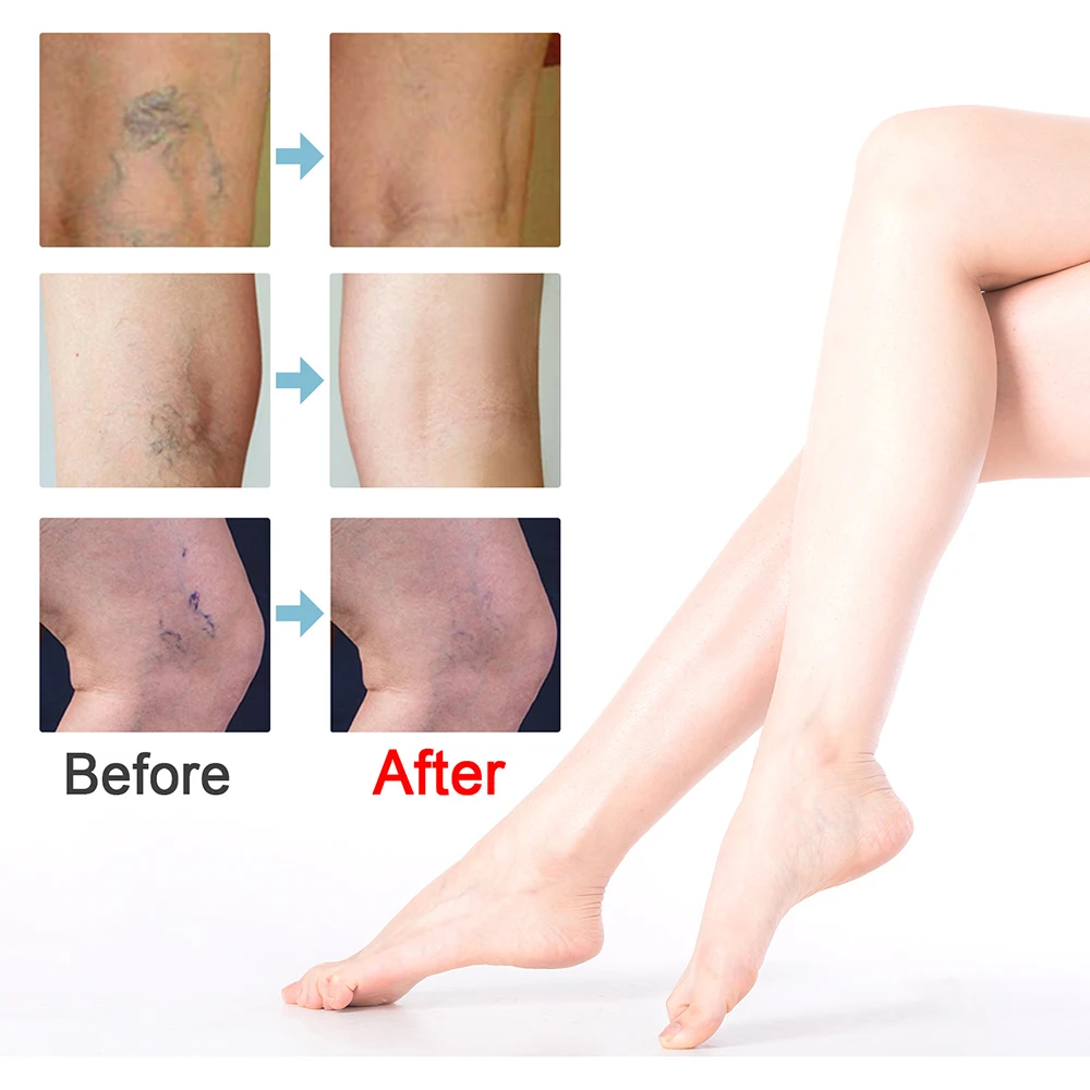 1/3/5/10/22pcs Varicose Vein Treatments Cream Effective Relieve Legs Dilated Vasculitis Phlebitis Natural Formula Ointment