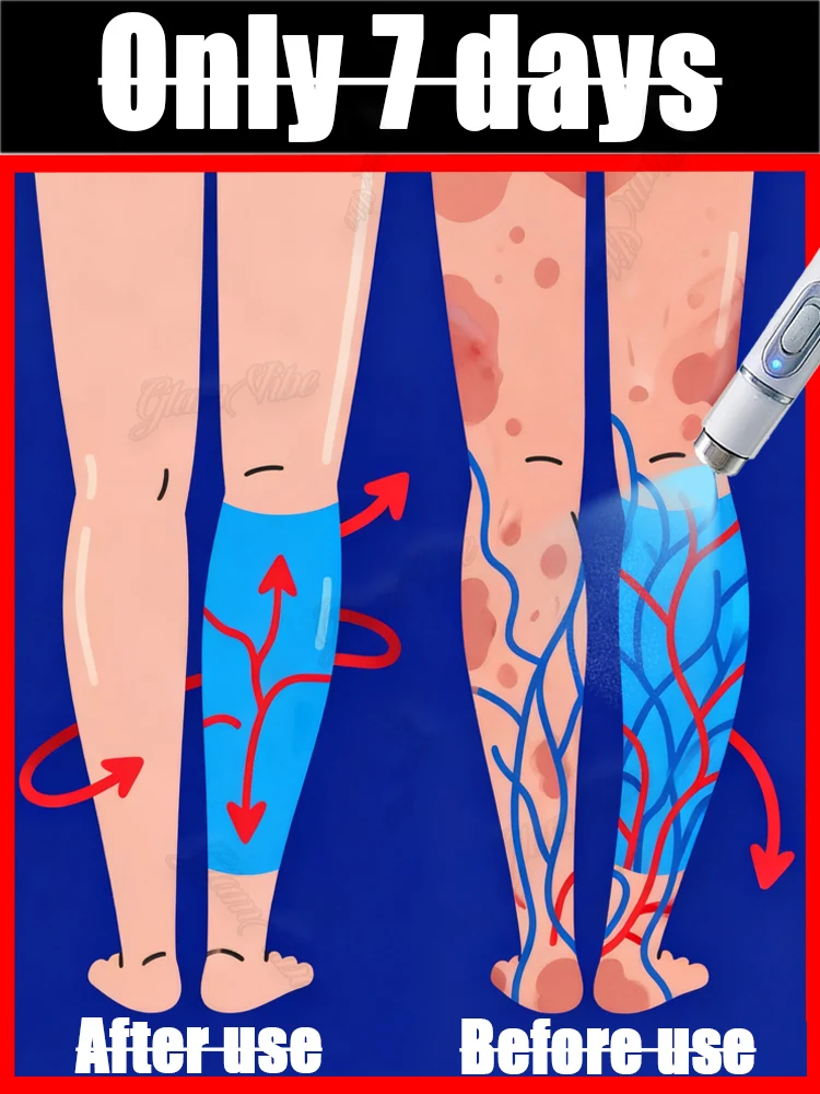 

Usᴇᴅ ᴛᴏ ʀᴇsᴛᴏʀᴇ ᴠᴀʀɪᴄᴏsᴇ ᴠᴇɪɴs ɪɴ 2025, ʟᴀsᴇʀ ᴠᴇɪɴ ᴛʀᴇᴀᴛᴍᴇɴᴛ ᴘᴇɴ