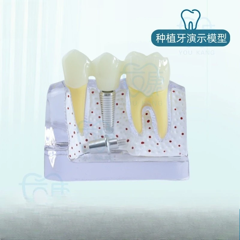 Dental implant model, simulation, oral teaching model, detachable teeth for dental implants