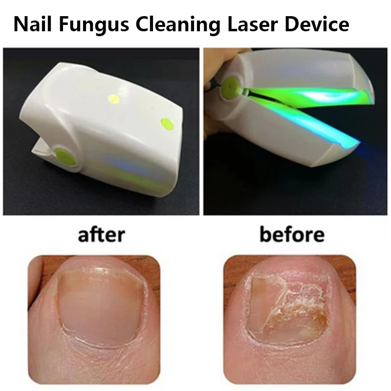 

Nail Clipper Gift Fungal Nail Treatment Stop Toenail Finger Toe Fungus Infection Antifungal Laser Device Light Therapy