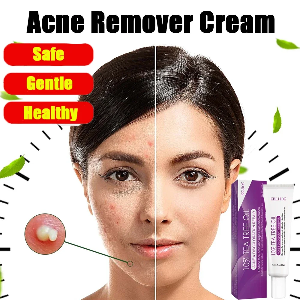 

Acne Remover Face Cream Moisturizing & Repairing Treatment, Pimple Remover, Shrink Pores, Oil Control Skin Care Cream