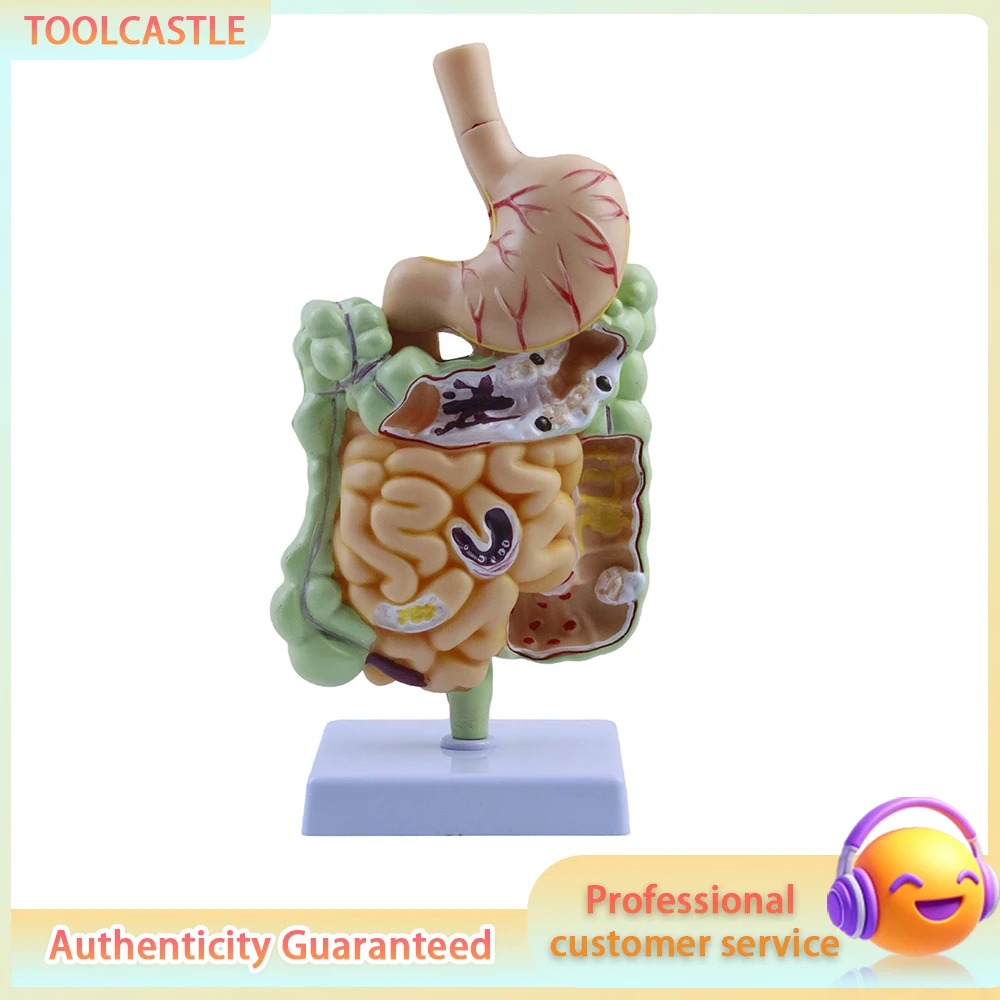 Human Large Intestine Pathological Model, Gastrointestinal Disease Anatomy Model with Stomach, Medical Teaching Tool