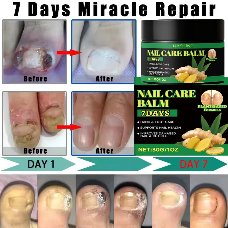 Nagel Schimmel Behandeling Crème Voet Teen Nagel Schimmel Verwijdering Essentiële Olie Anti Infectie Onychomycose Paronychia Repareren Zorg