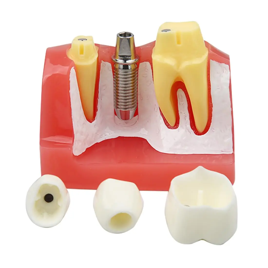 Image 3: Modèle d'implant dentaire AG, pont de couronne amovible, modèle de démonstration de dents 4 fois pour l'enseignement, l'éducation des patients