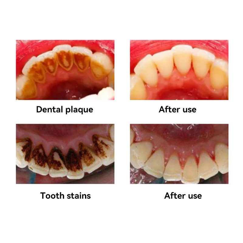 Ультразвуковой очиститель зубов, очиститель зубов, бытовая чистка, желтые зубы, пятна дыма, отбеливание зубов, очиститель зубов