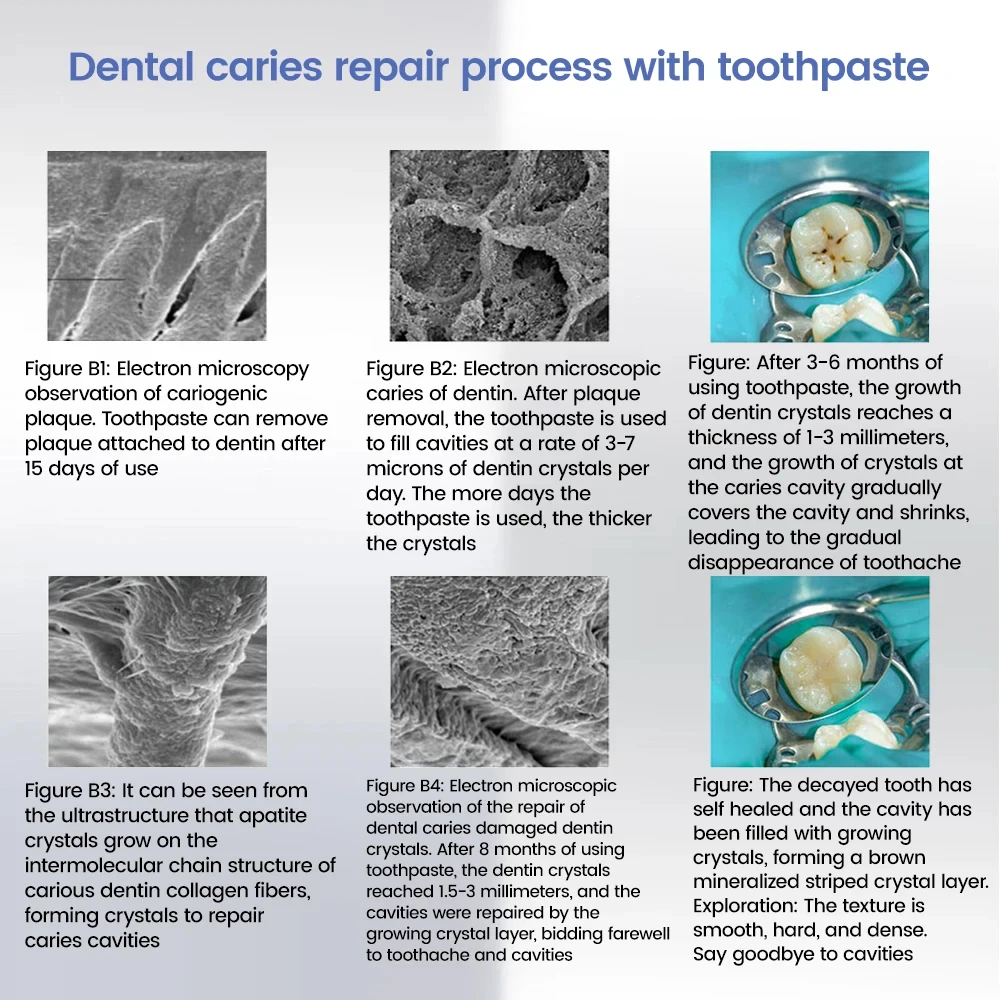 2023 Quick Repair of Cavities Caries Removal of Plaque Stains Decay Whitening Yellowing Repair Teeth Teeth Whitening New Upgrade