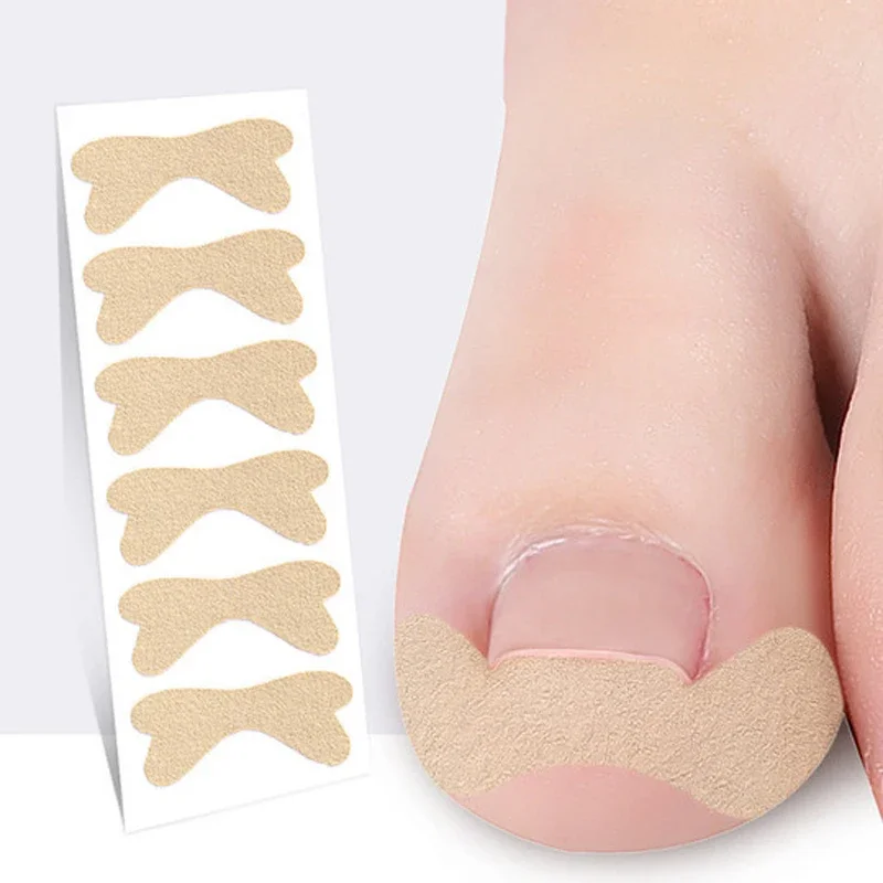 1/3/5SET Patches Treatment Sticker Inlay Nail Corrector Stickers Ingrown Toenail Toenail Correction Stickers Toenail Corrector