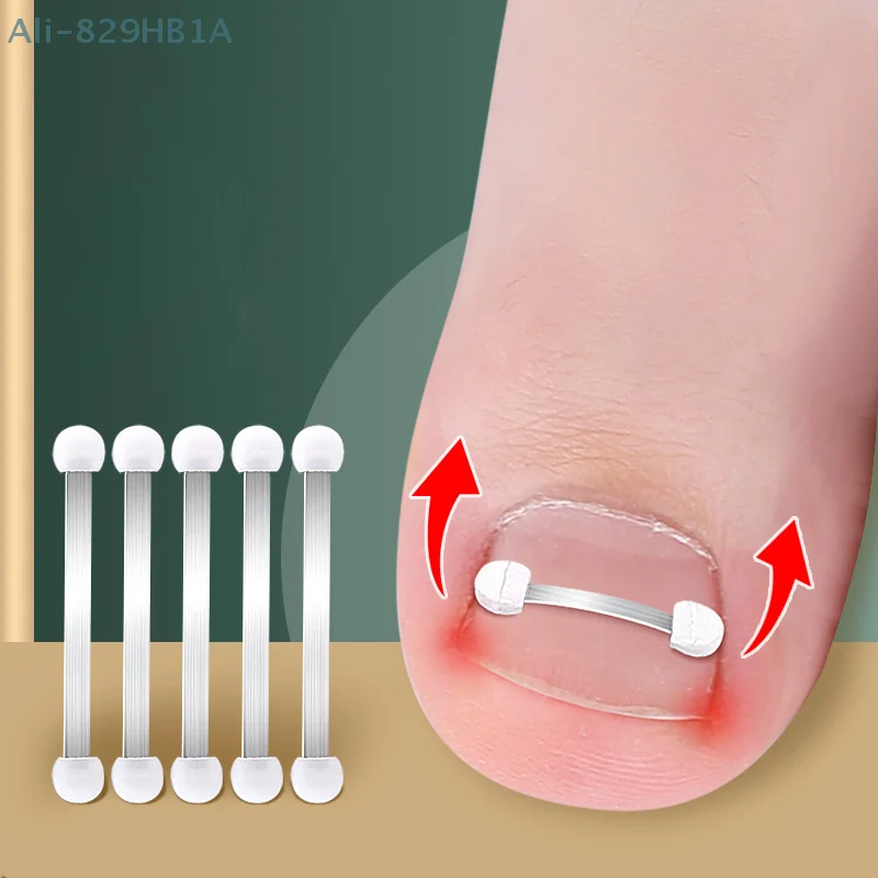 Ingrown Toenail Corrector Tools Pedicure Recover Embed Toe Nail Treatment Professional Ingrown Toenail Correction Foot Care Tool