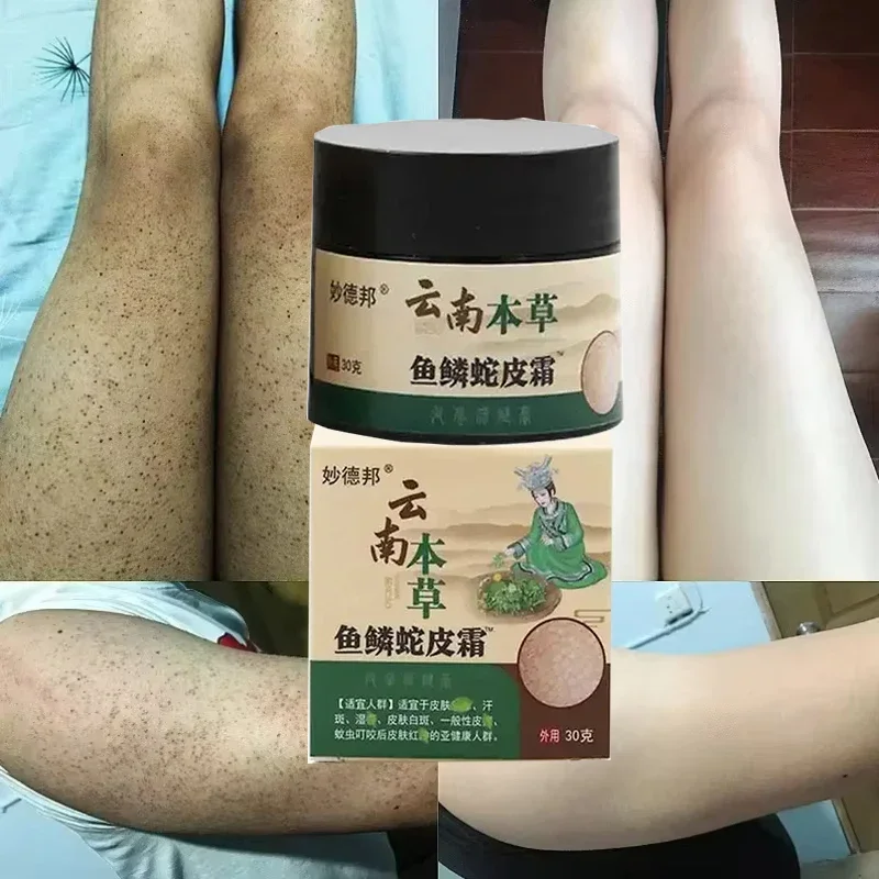 Chicken Skin Repair Cream Curing Keratosis Follicle Pilaris Body Dark Spot Remove Thick Pores Moisturizing Smooth Essence