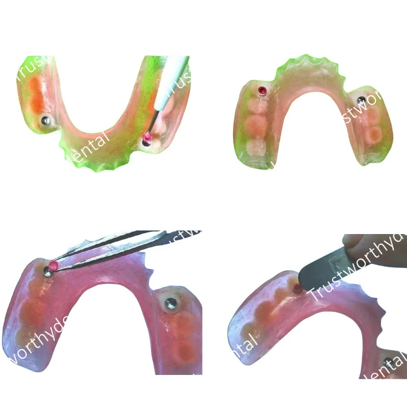 Dental Overdenture Locator Caps Attachment Denture Restorations Castable Ball Metal Housing Retention Style