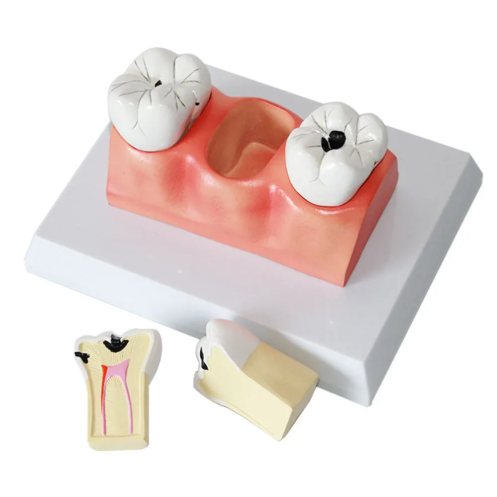 Dental Department: Pediatric Insect Tooth Decay Model, Pathological Caries Anatomy Model