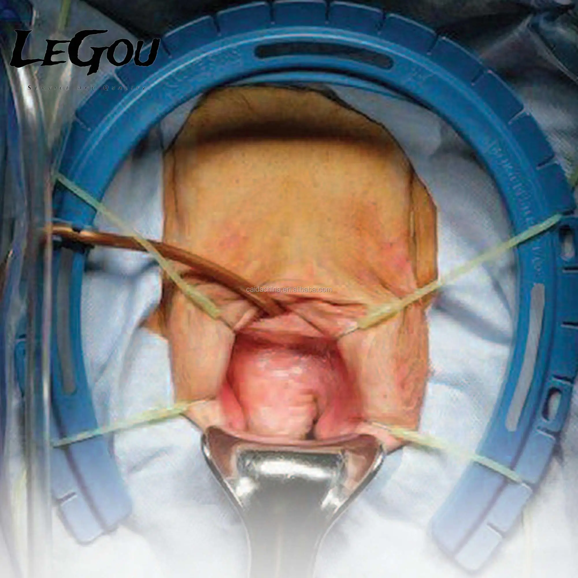 Single use Surgical genecology retractor ring,disposable retractor ring R02