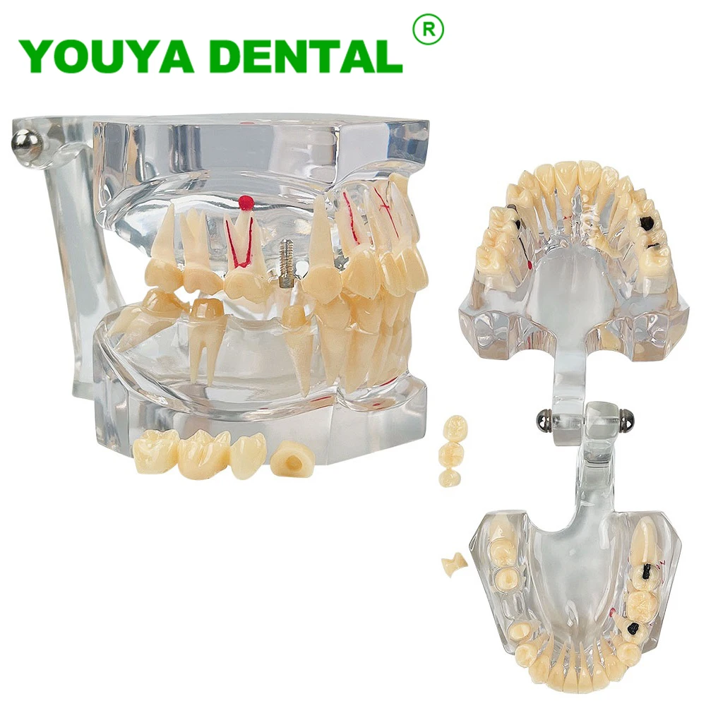 

Dental Pathological Model 2.5 Times Typodont Teeth Disease Model Transparent Jaw Model Dentistry Dentist Demonstration Models