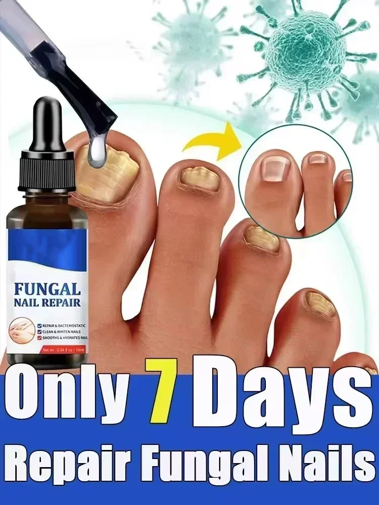 ⁿⁱᶜᵉ Toenail Nail Fungus Treatment Repair Fingernail Device Toenail Treatment for Foot Nail Fungus Essential Oil Onychomycosis C