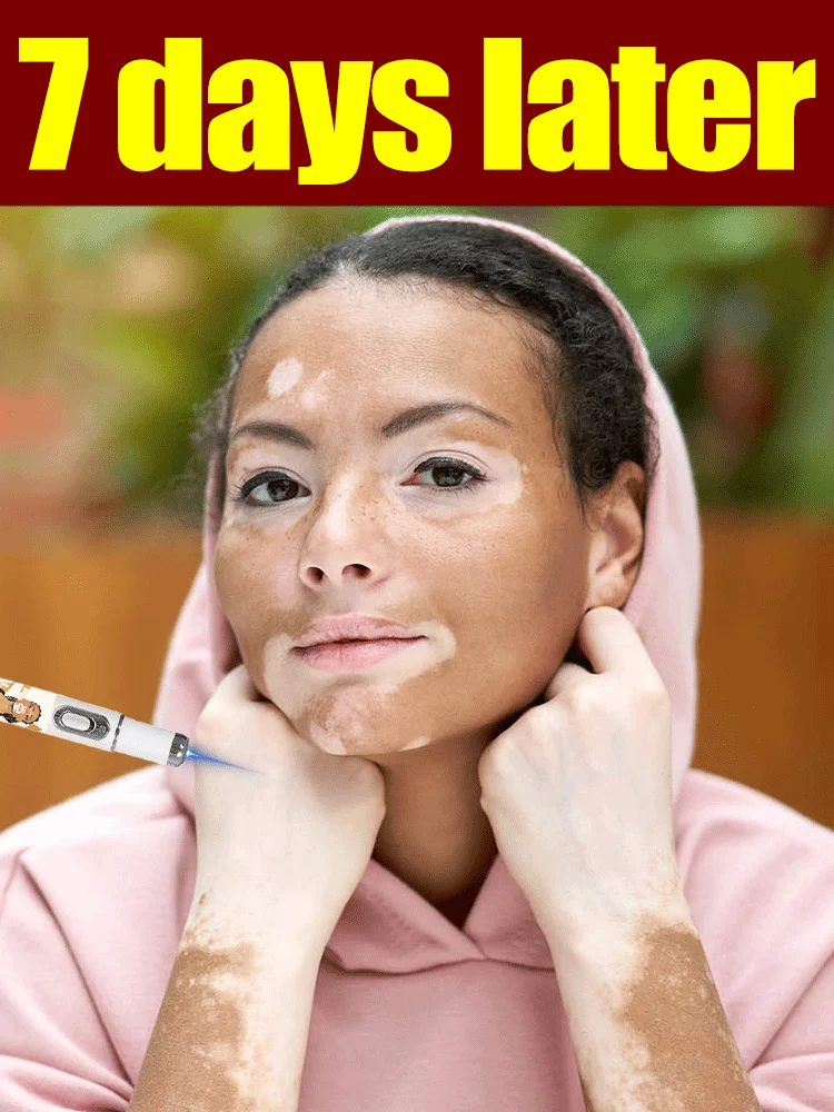 

Vitiligo Treatment Device 2nd Upgraded Version⸴Vitiligo Treatment⸴Fast