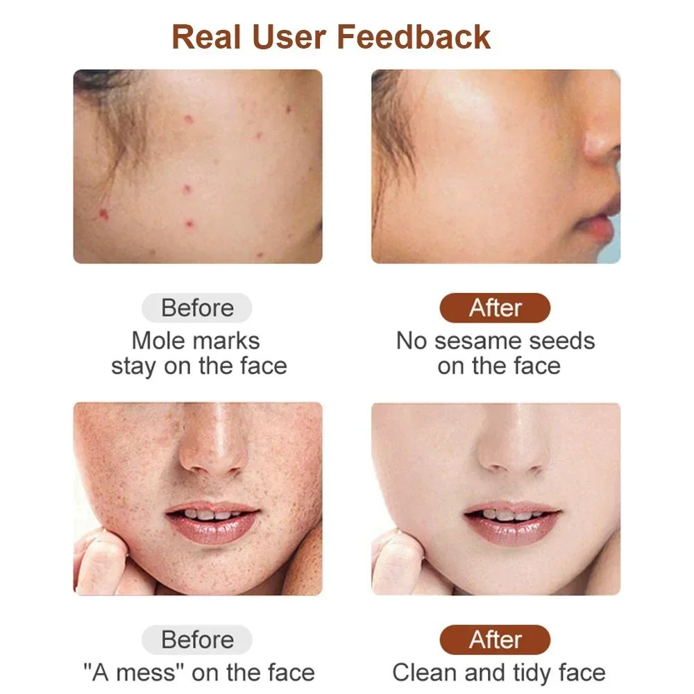 Skin Tag Remover ไฟฟ้าแท็กผิวกําจัด Dark Spot Mole Remover ปากกากระหูด Tattoo Nevus จุดด่างดําเลเซอร์พลาสม่าปากกา