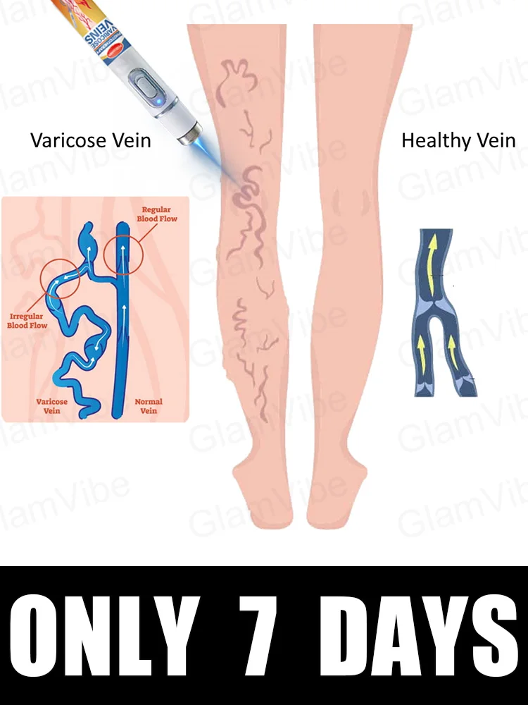 

blue light pen solve varicose veins, hot sale leg care tools