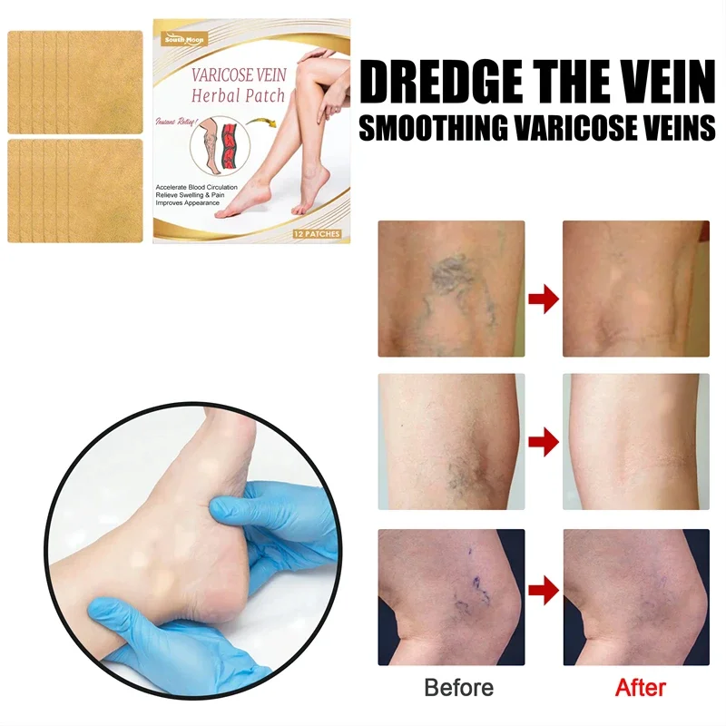 12pcs Varicose Vein Repair Patches Effective Relieves Leg Bulge Pain Treatment Sticker Vasculitis Phlebitis Remove Spider Veins