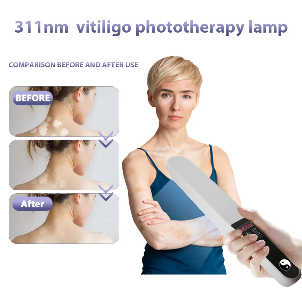

311nm Ultraviolet Phototherapy Instrument use UVB Philips Lamp UV for Vitiligo Psoriasis White Spots Skin Disease