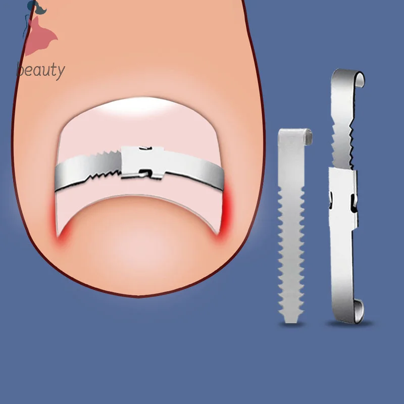 أدوات مصحح أظافر القدم النامية للعناية بالأقدام ، علاج أظافر أصابع القدم المدمجة ، تصحيح أظافر القدم النامية الاحترافية ، أداة العناية بالقدم