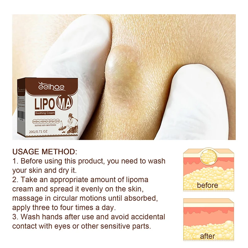 Soothing Cream Subcutaneous Lumps Remover Treatment Medicine Liquid Apply To Skin Swelling Cellulite Fibroma Fat Mass Plaster