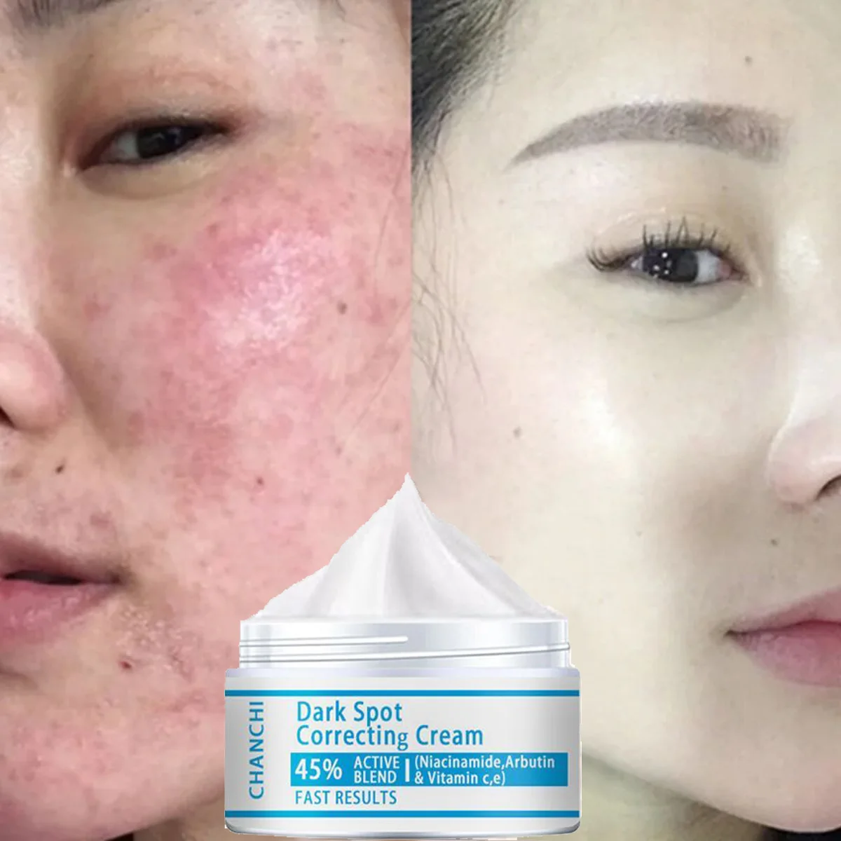 hyaluronic acid cream to lighten acne marks skin care  firming skin tightening cream