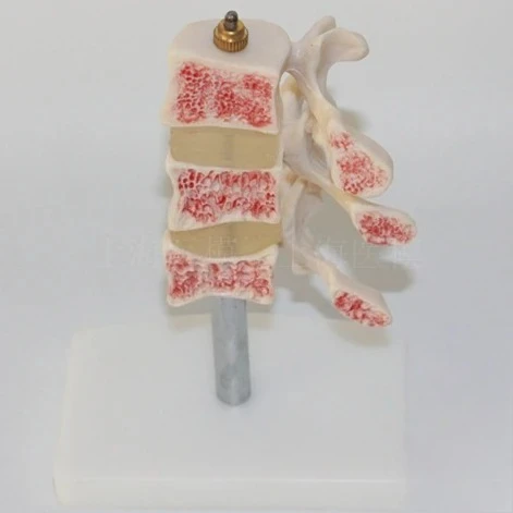 

Lesion spinal model Spine model Intervertebral disc model