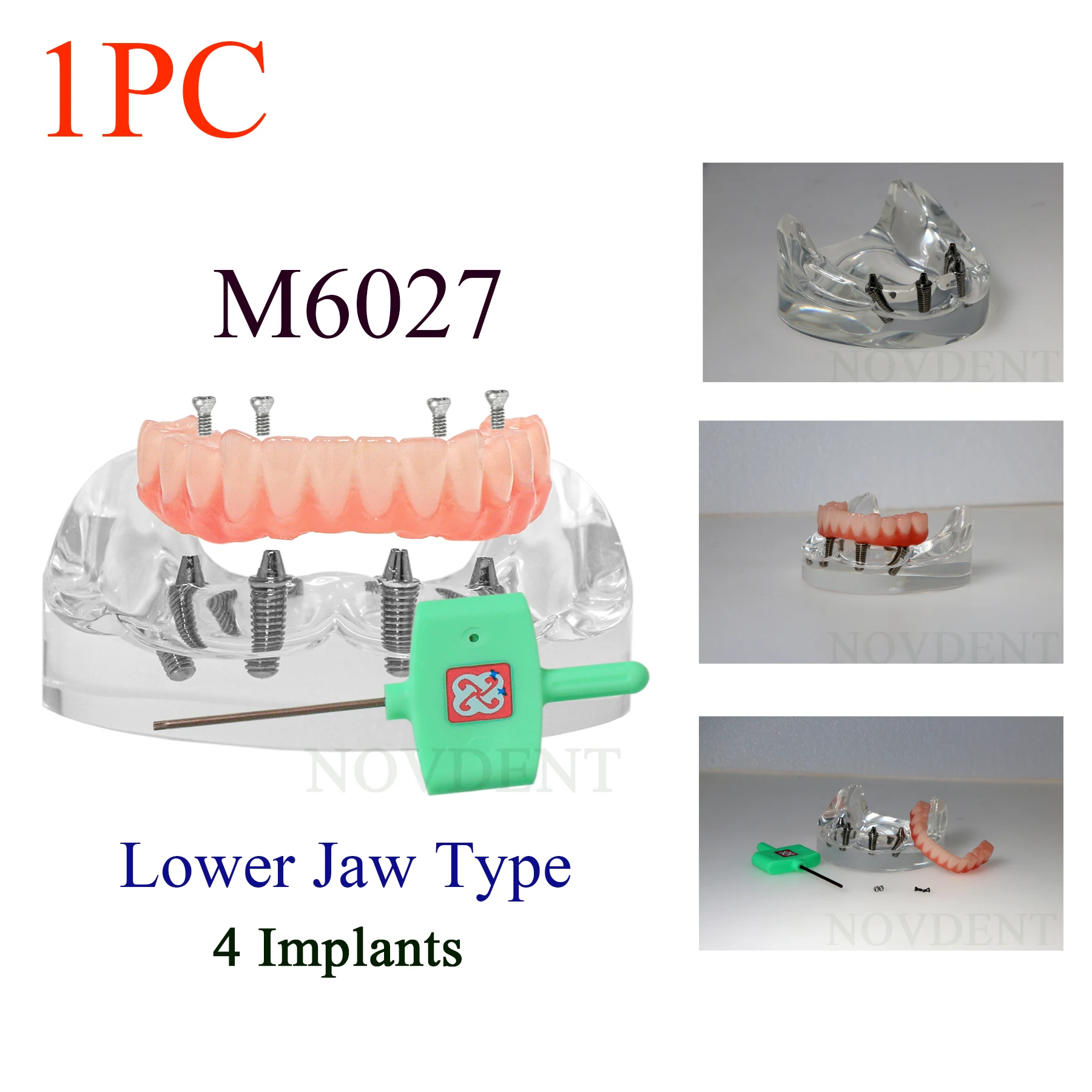 1Pc Dental Implant Model Lower Jaw 4 Implants Overdenture Restoration Removable Teeth Model Dentisit Teaching Demo Model