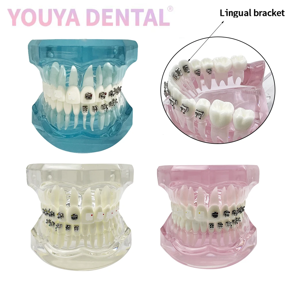 Dental Self-Locking Ceramic Metal Lingual Bracket Comparison Model Typodont Orthodontic Tooth Model For Dentist Demonstration