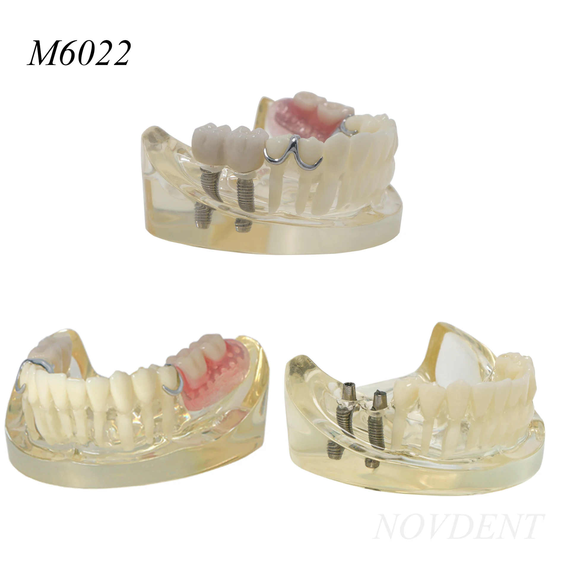 Dental Teeth Model M6022 2 Implants Removable Dental Teaching Research Demonstrations 1 Set