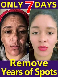 Freckle Whitening Cream Melasma Removal Dark Spots Fade Brighten