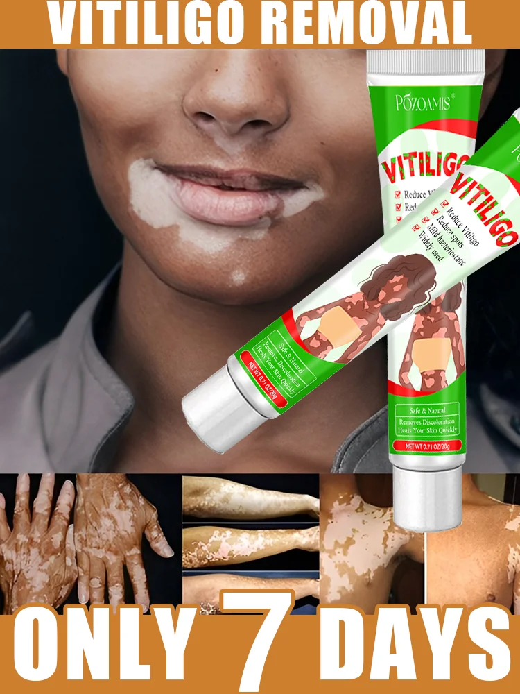 Witte Vlekken Verwijderen, Vitiligo Crème