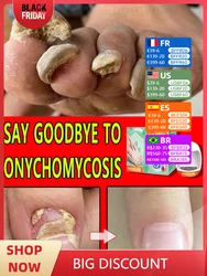 Fungal Nail Repair Fast Onychomycosis Fungus Nails