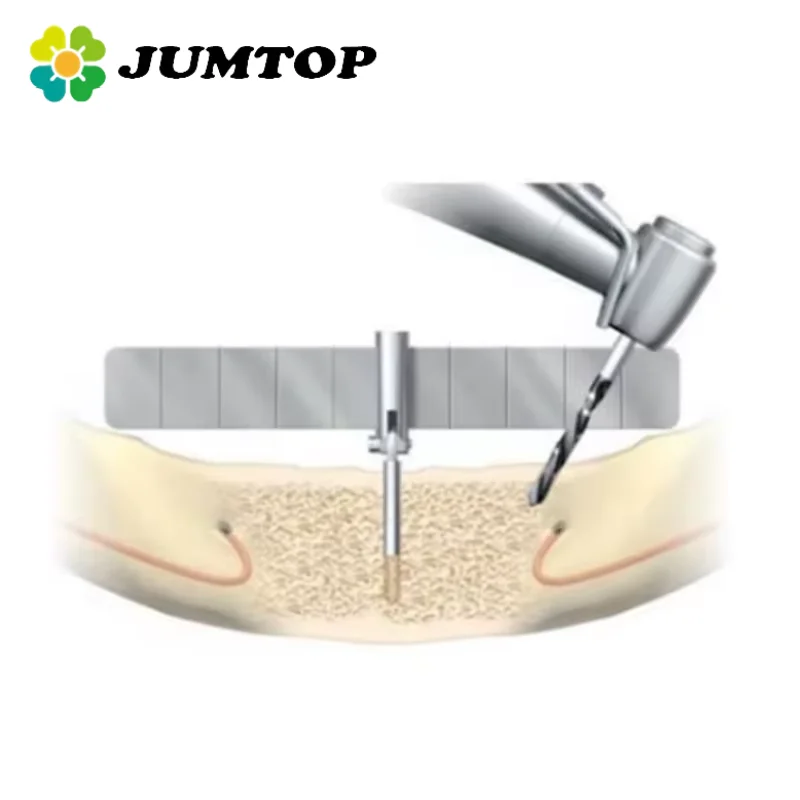 

JUMTOP 1 Set Dental Implant Locating Guide Surgical Planting Positioning Locator Angle Ruler With Extra Replace Rule
