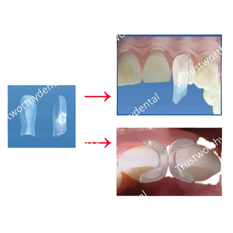 30Pcs Dental Clear Matrix Bow Przednie przednie matryce Opaski Przezroczyste czarne trójkątne odbudowa