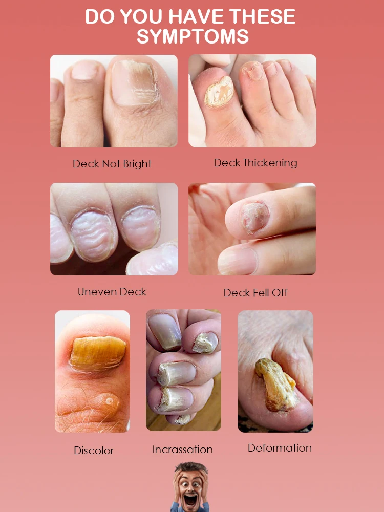 Reducing Infections Fungal Nail R-epair