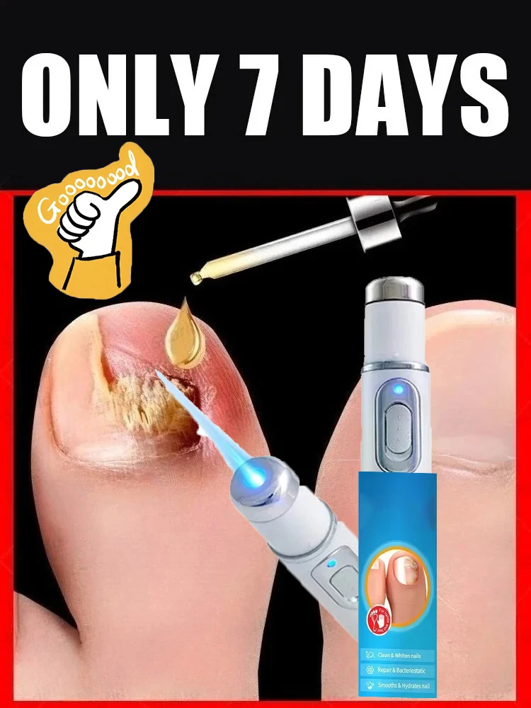 

Nail Cleaning Tools, Blue Light Laser Tools Root Repair Upgraded to Second Generation 26