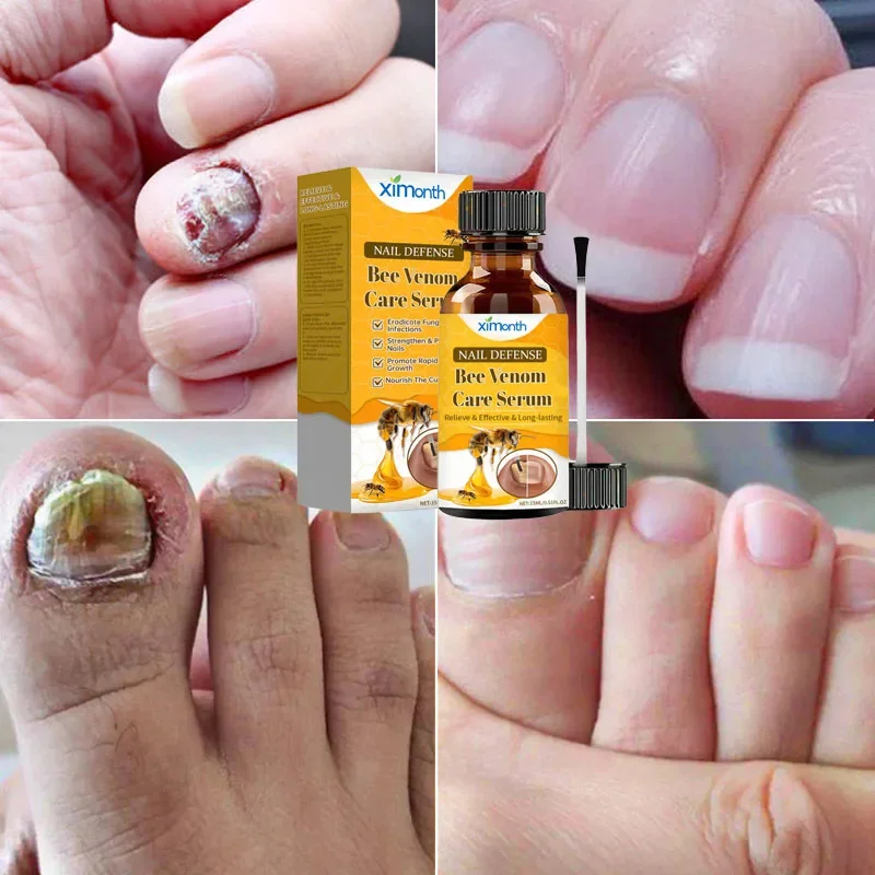 손발톱 무좀 치료 세럼 발가락 손발톱 무좀 제거 에센셜 오일 항균 손발톱진균증 손발톱 주위염 치료 관리