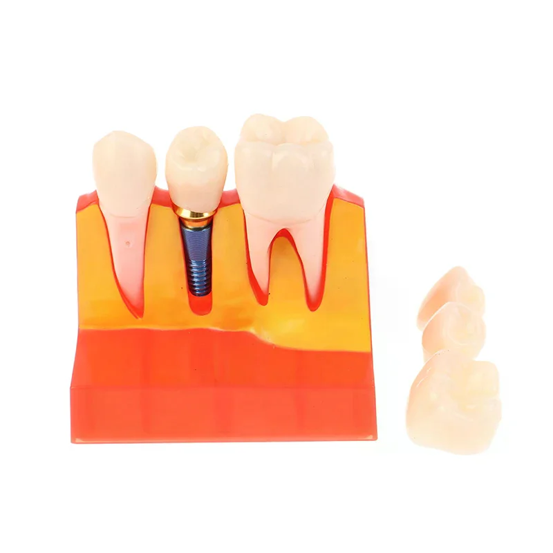 4 Times Implant Teeth Model Analysis Crown Bridge Demonstration Removable Model Dentistry Study Training Teaching Model Dental