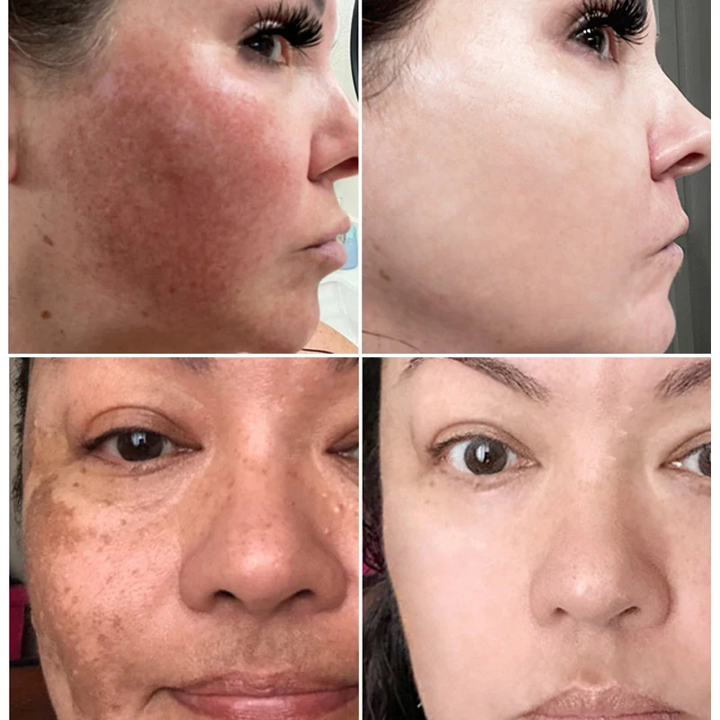 Crema blanqueadora para pecas, elimina eficazmente el Melasma, manchas oscuras, pigmentación, hidrata, ilumina suavemente la piel facial, producto para el cuidado de la piel