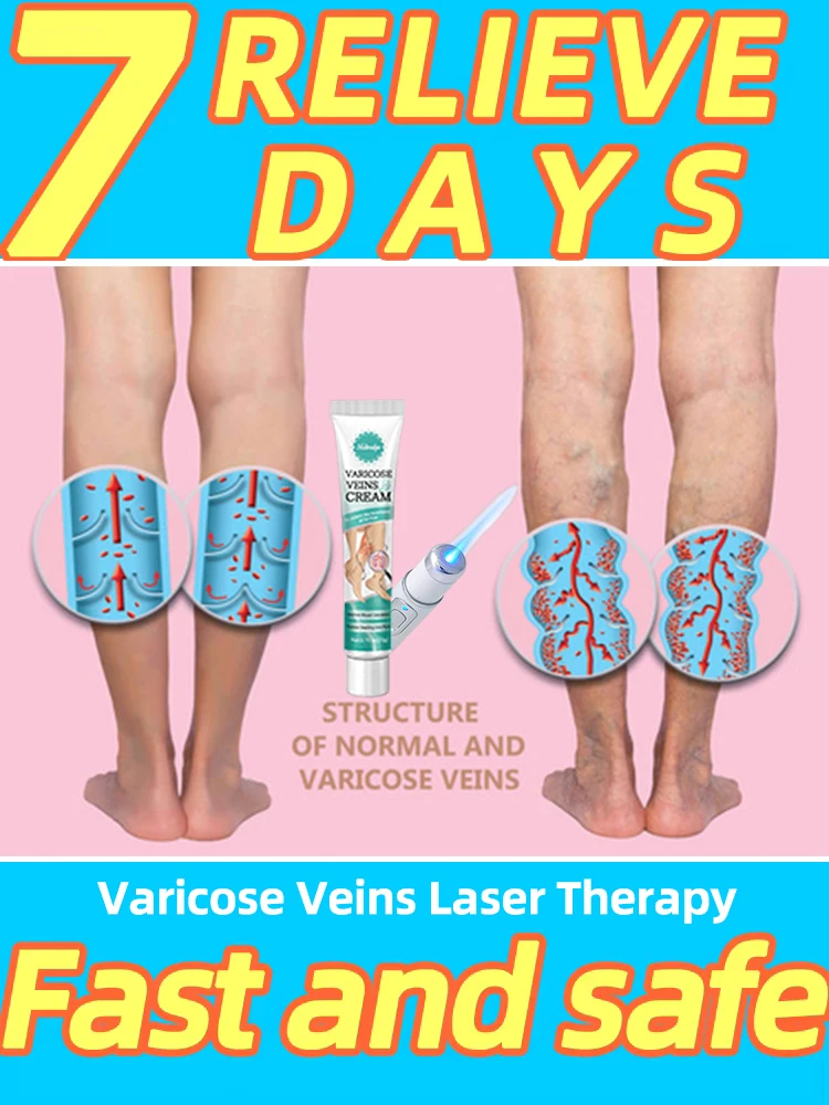 

Blue Laser Heals Leg Veins