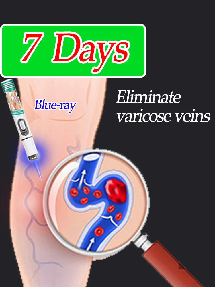 

Vein blue light tool calf and thigh care tools Say goodbye to varicose veins